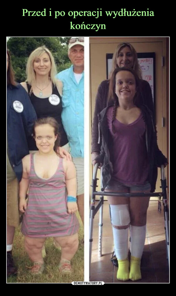 Przed i po operacji 
wydłużenia kończyn